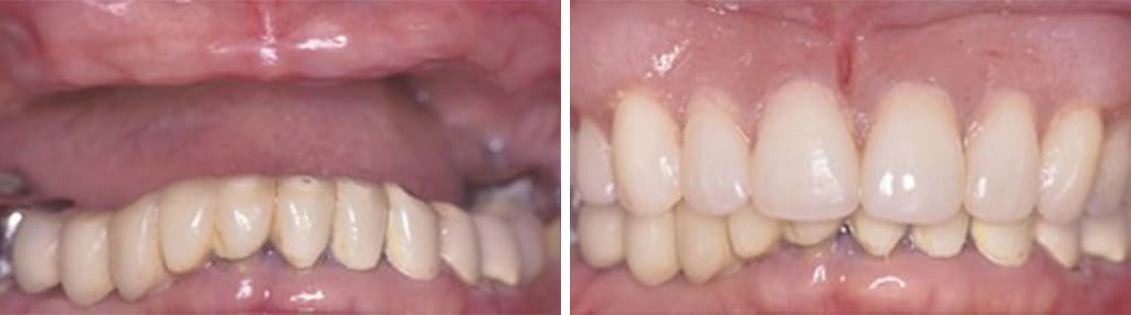 Before & After | Crowns, Implants & Dentures
