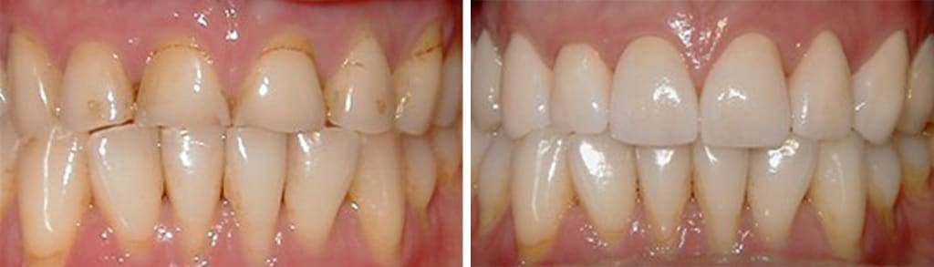 Before & After | Crowns